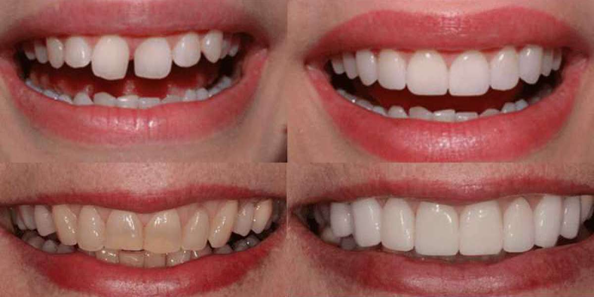Dental veneers Etobicoke