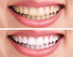 Teeth Whitening Adelaide | Professional Teeth Whitening | Munno Para Dental