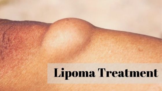 Use Natural Home Remedies for Curing Lipoma without Surgery