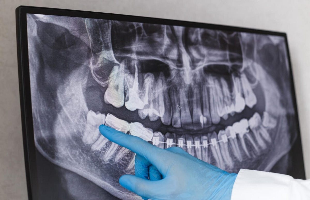 How Dental Radiographs Help You Get A Picture-Perfect Smile? | by Gateway Little Smiles | Aug, 2023 | Medium