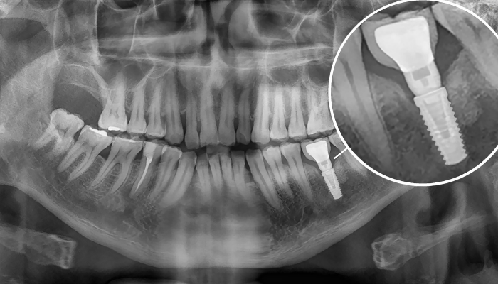 How Your Jaw Bonds with Dental Implants?
