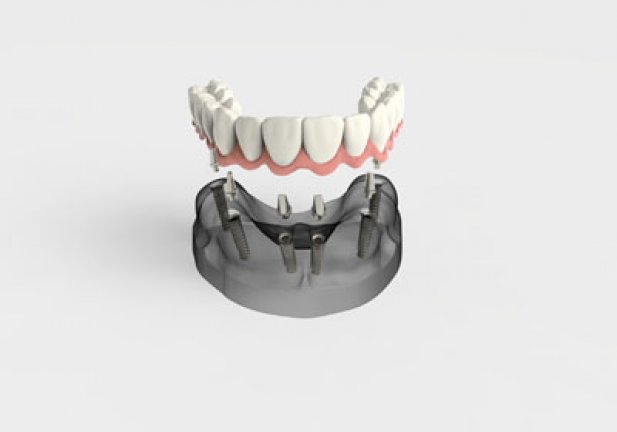 How Do Dentures Stay In Place? Article - ArticleTed -  News and Articles