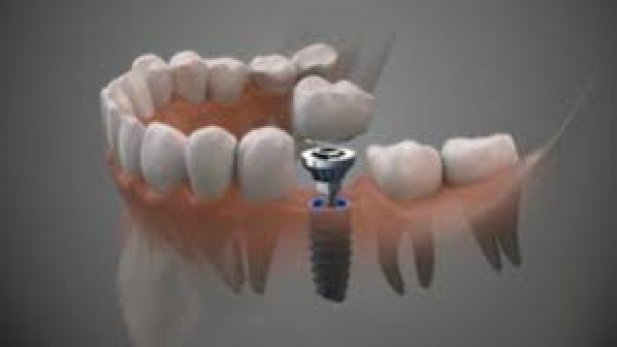 How Quickly Will Dental Implants Heal? Article - ArticleTed -  News and Articles