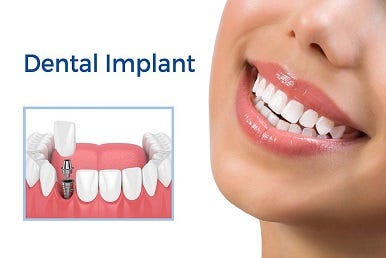 Enhance Your Smile with Dental Implants: What to Expect | by Cleopatra Dental | Apr, 2024 | Medium