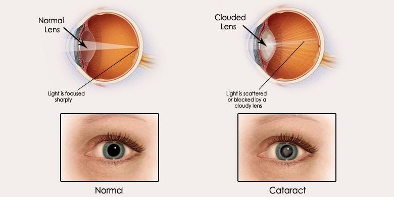 Expert Cataract Surgeon in Gurgaon: Advanced Treatment Options | Medium