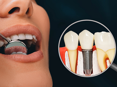 Can I Get Dental Implants if I Had Chemotherapy? | by Sunrise Smiles | Apr, 2024 | Medium