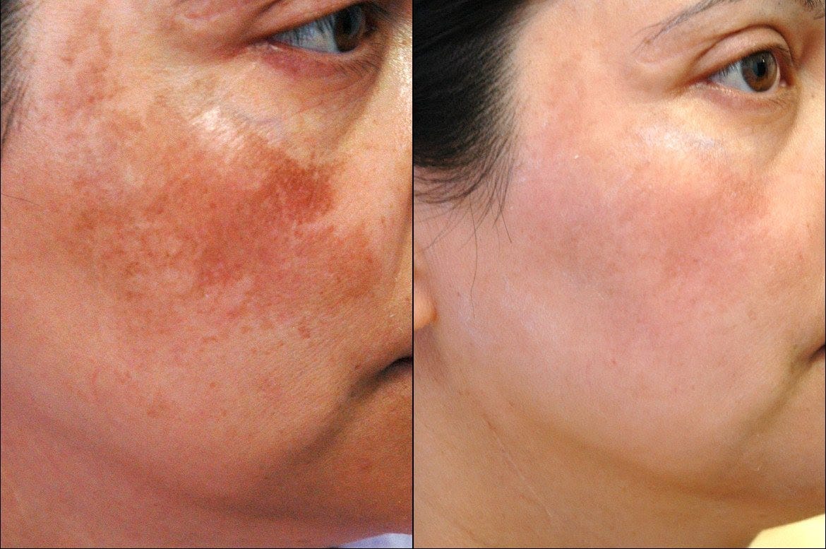 Laser Skin Rejuvenation: Eliminating Dark Spots & Pigmentation | Medium